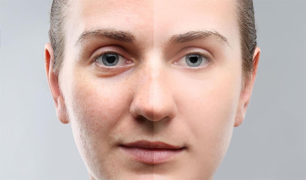 Blefaroplastia: qué es y qué resultados obtenemos 