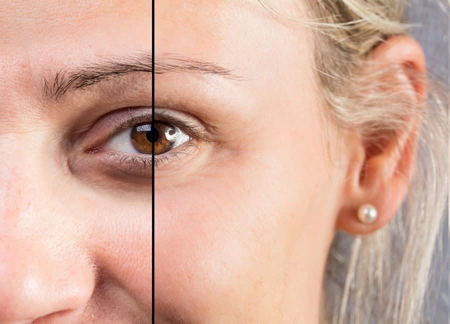 Blefaroplastia: ¿qué es?