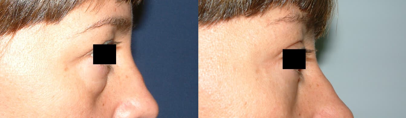 Blefaroplastia antes/después