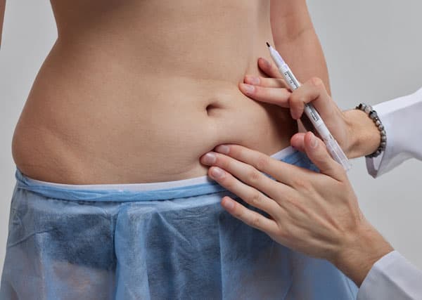 Dermolipectomía abdominal en Vigo