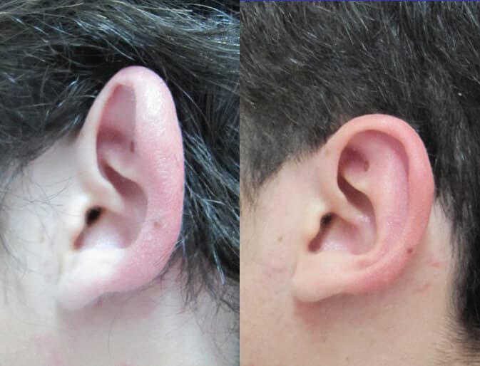 Otoplastia antes/después