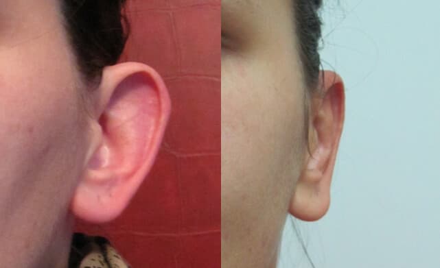 Otoplastia antes/después