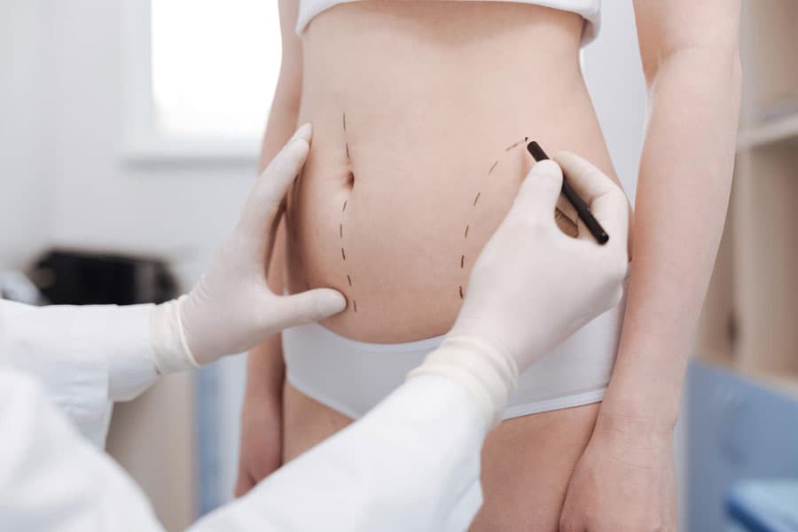 Preguntas frecuentes sobre la abdominoplastia en Vigo
