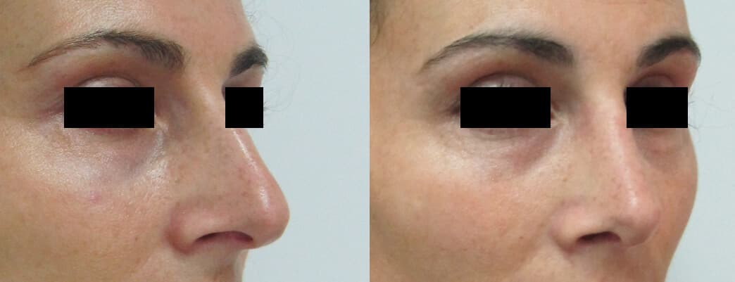 Rinoplastia antes/después