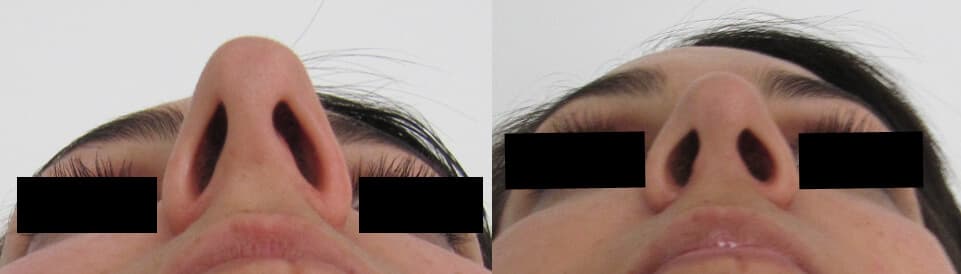 Rinoplastia antes/después