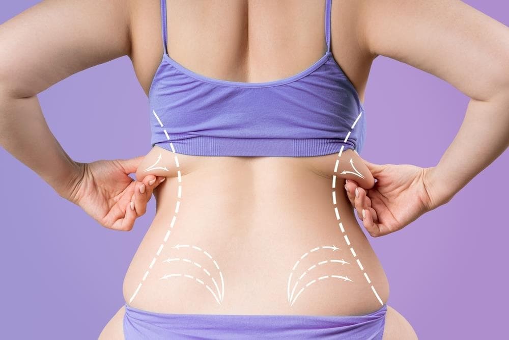 Liposucción: mitos y realidades