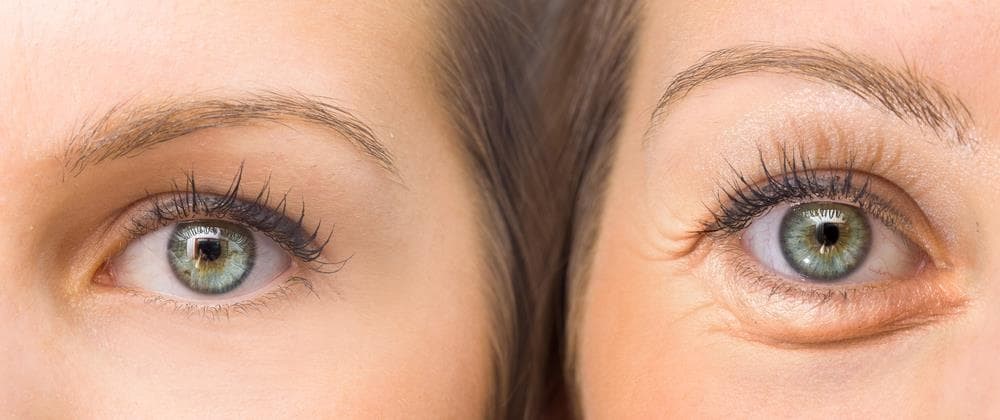 ¿Puede la blefaroplastia mejorar la visión?
